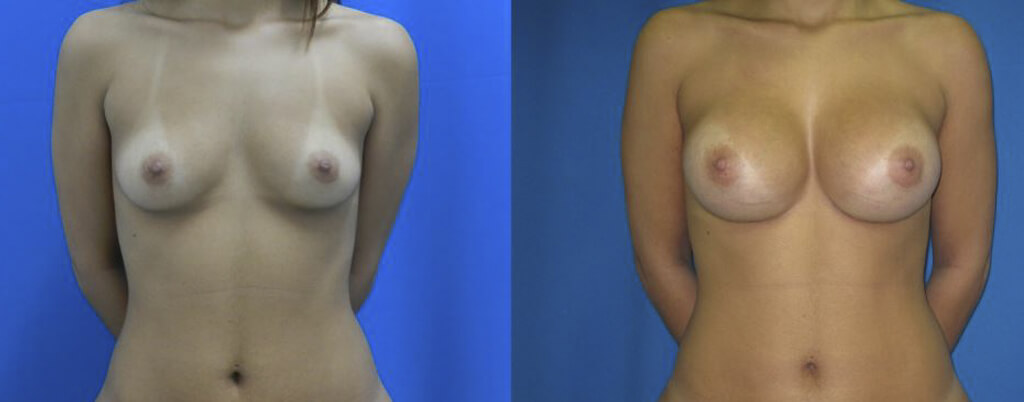 Aumento de senos mamoplastica Clinica HUM
